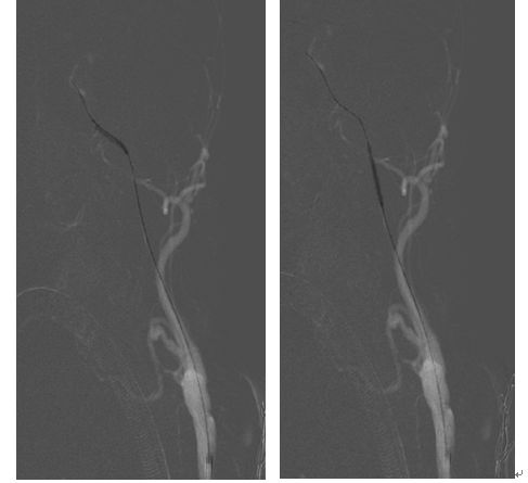 学术快报｜莫大鹏：颈动脉病变的复合手术治疗原则