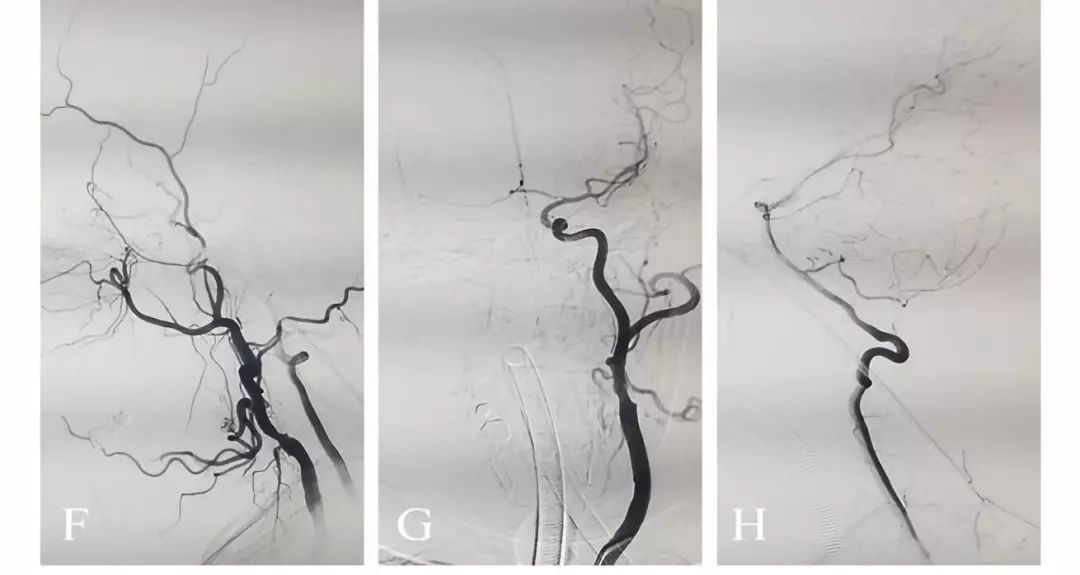 学术快报｜莫大鹏：颈动脉病变的复合手术治疗原则