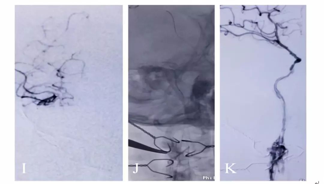 学术快报｜莫大鹏：颈动脉病变的复合手术治疗原则