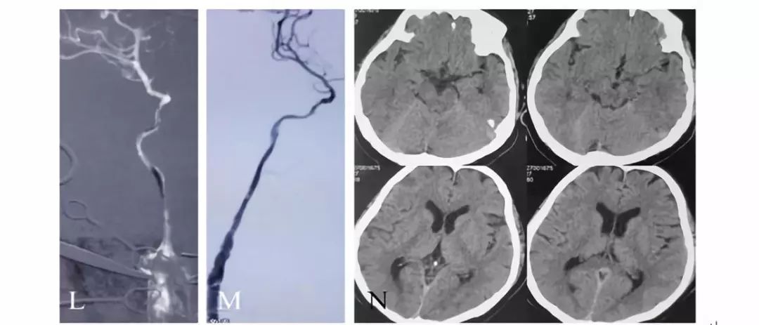 学术快报｜莫大鹏：颈动脉病变的复合手术治疗原则