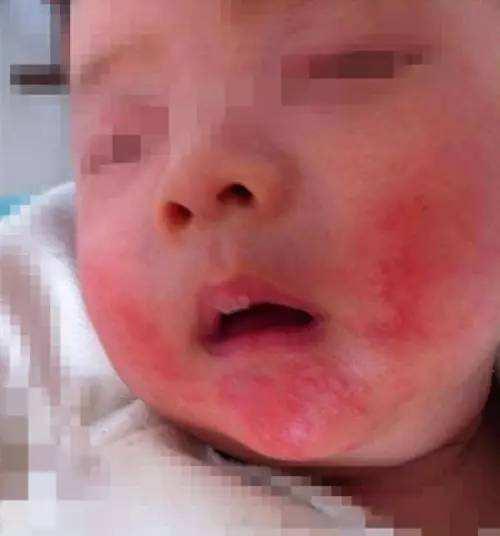 宝宝湿疹反复太难缠，对抗湿疹有办法，妈妈们弄懂这些很有必要