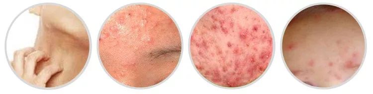 杀灭螨虫的中草药,天然除螨包去除螨虫