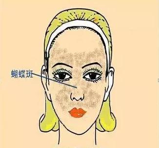 色斑一般在什么位置,你知道色斑分几个种类吗