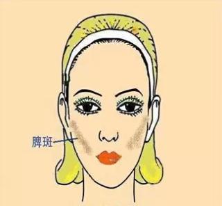 色斑一般在什么位置,你知道色斑分几个种类吗