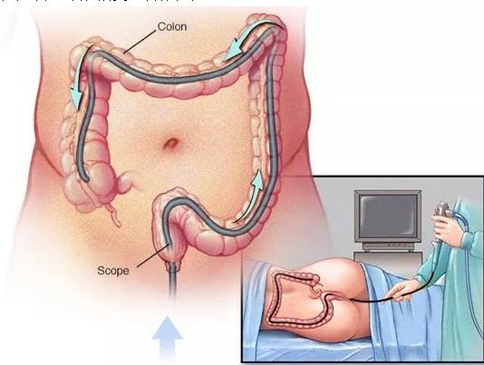 有多少人害怕做胃肠镜,害怕做无痛胃肠镜