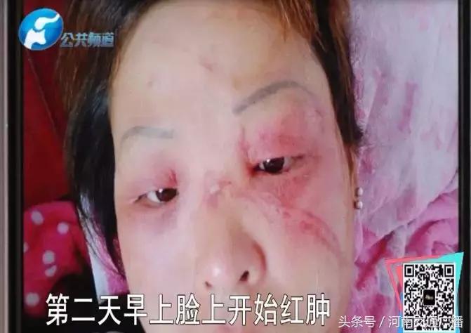 100块10盒面膜毁容事件,女人惨遭毁容后续