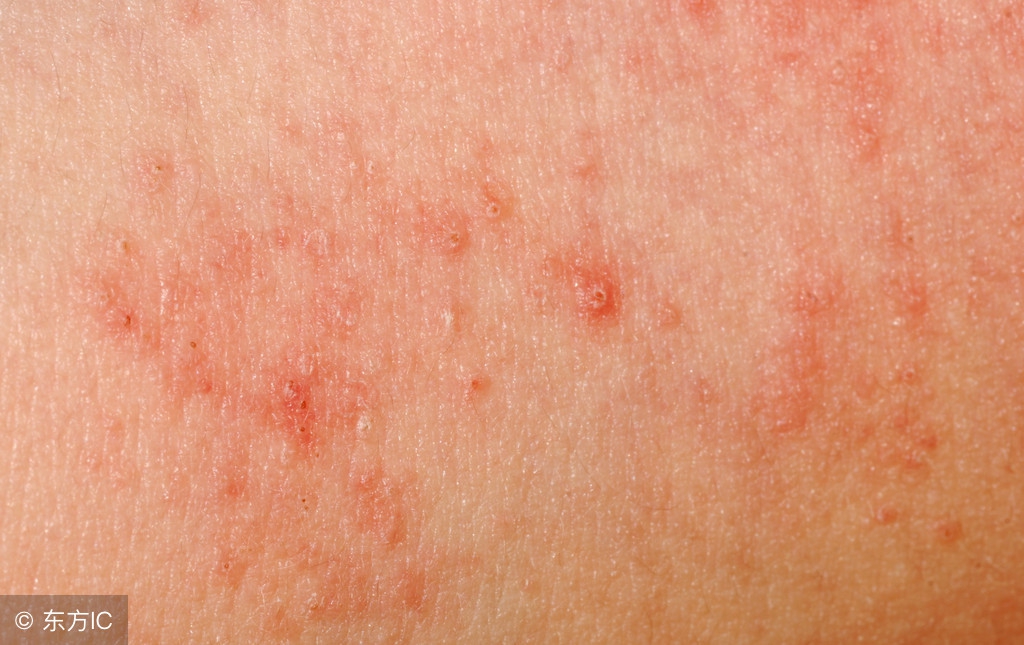 脸上的皮炎怎么才能彻底治愈,脸上得了皮炎怎么办