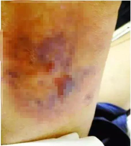 海南海鲜市场老板被鱼咬断手指,海口买海鲜被鱼咬断手指头