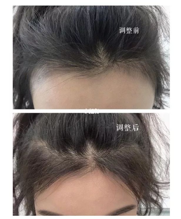 男人发际线后移怎么拯救,如何拯救发际线后移