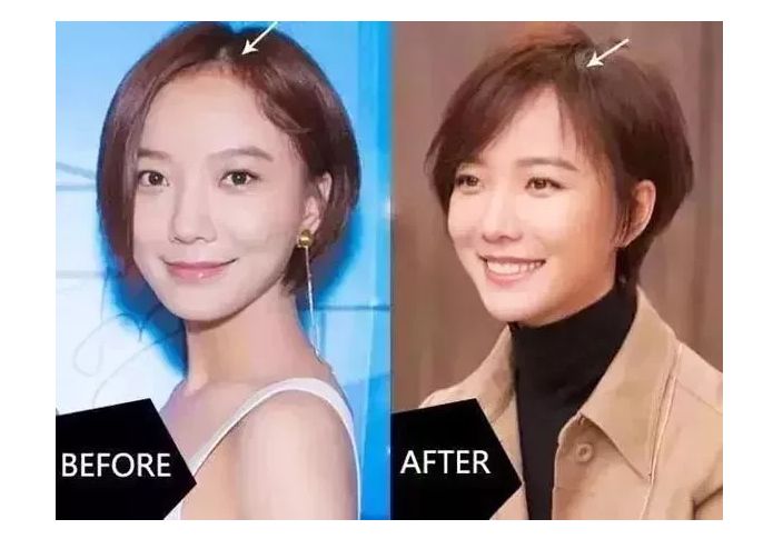 男人发际线后移怎么拯救,如何拯救发际线后移