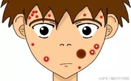 「答疑」为什么过了青春期还会长“青春痘”?