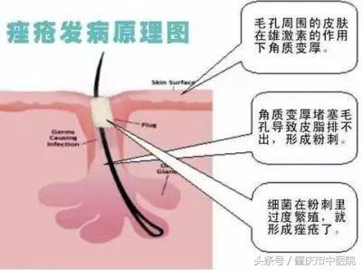 「答疑」为什么过了青春期还会长“青春痘”?