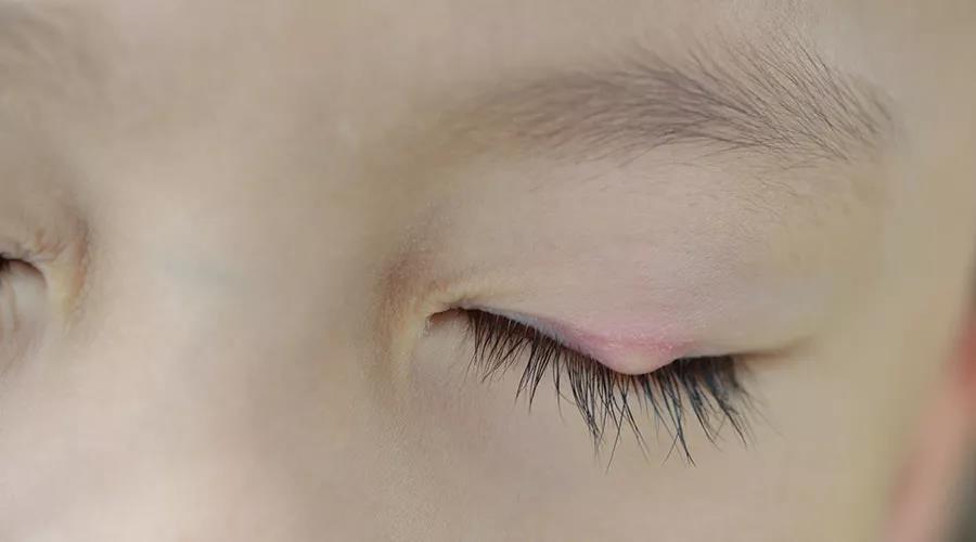 眼睛上长痘痘可以热敷么,眼睛上长痘痘可以扎破吗