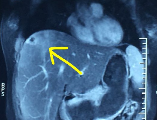 肝癌消融后肝内转移会误诊吗,肝癌肿瘤破裂介入后休克