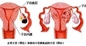 子宫肌瘤合并腺肌症可以吃鸡蛋吗,子宫肌瘤合并腺肌瘤怎么处理