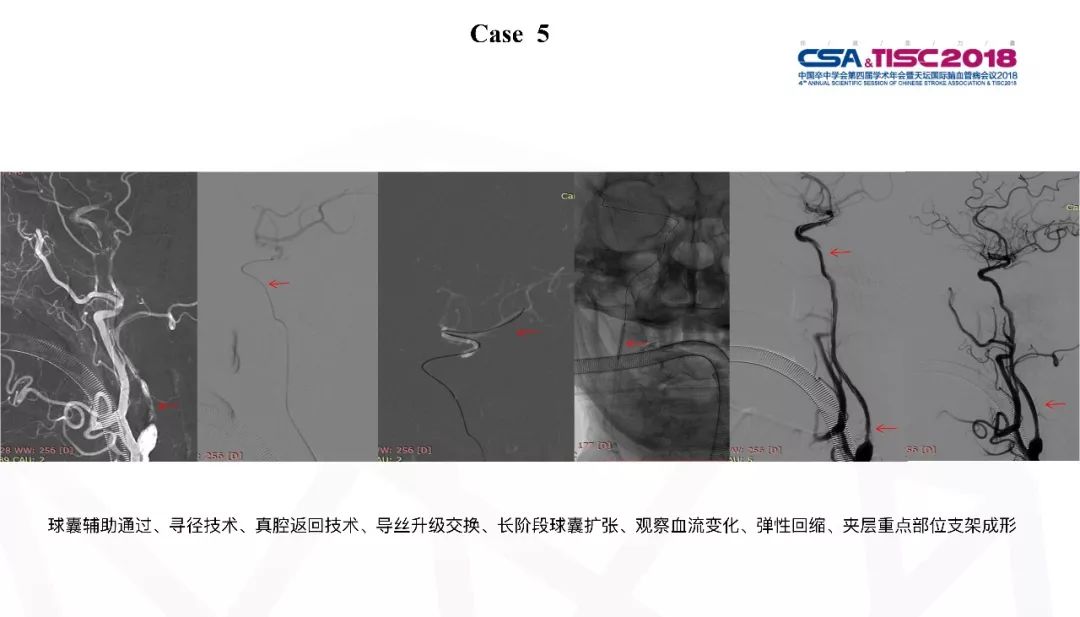 颈动脉狭窄介入治疗术后血压管理,专家讲解颈动脉狭窄的诊疗