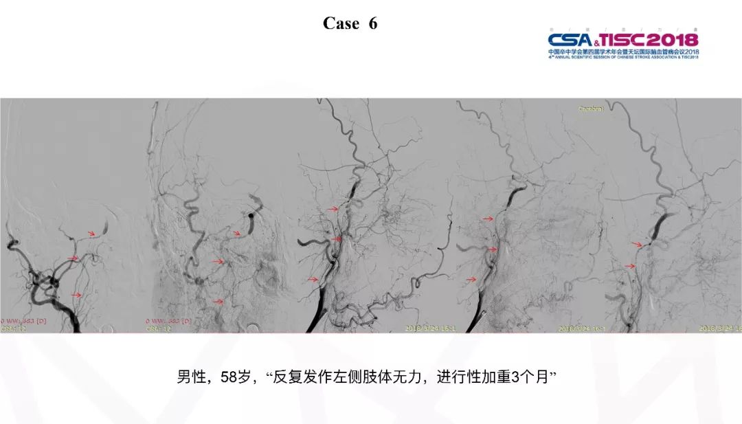 颈动脉狭窄介入治疗术后血压管理,专家讲解颈动脉狭窄的诊疗