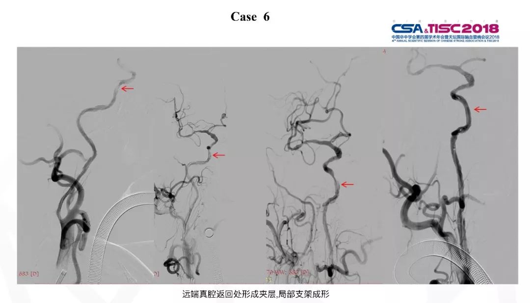 颈动脉狭窄介入治疗术后血压管理,专家讲解颈动脉狭窄的诊疗