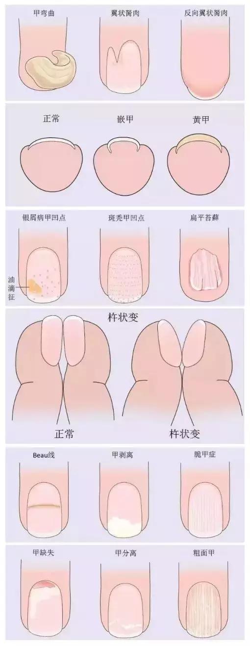 甲旁型灰指甲怎么治疗能彻底除根,灰指甲拔甲后更加难治疗