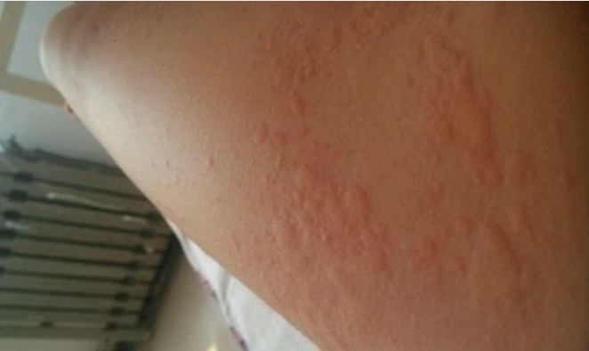 荨麻疹最强攻略赶紧收藏下吧,荨麻疹史上最强攻略赶紧收藏