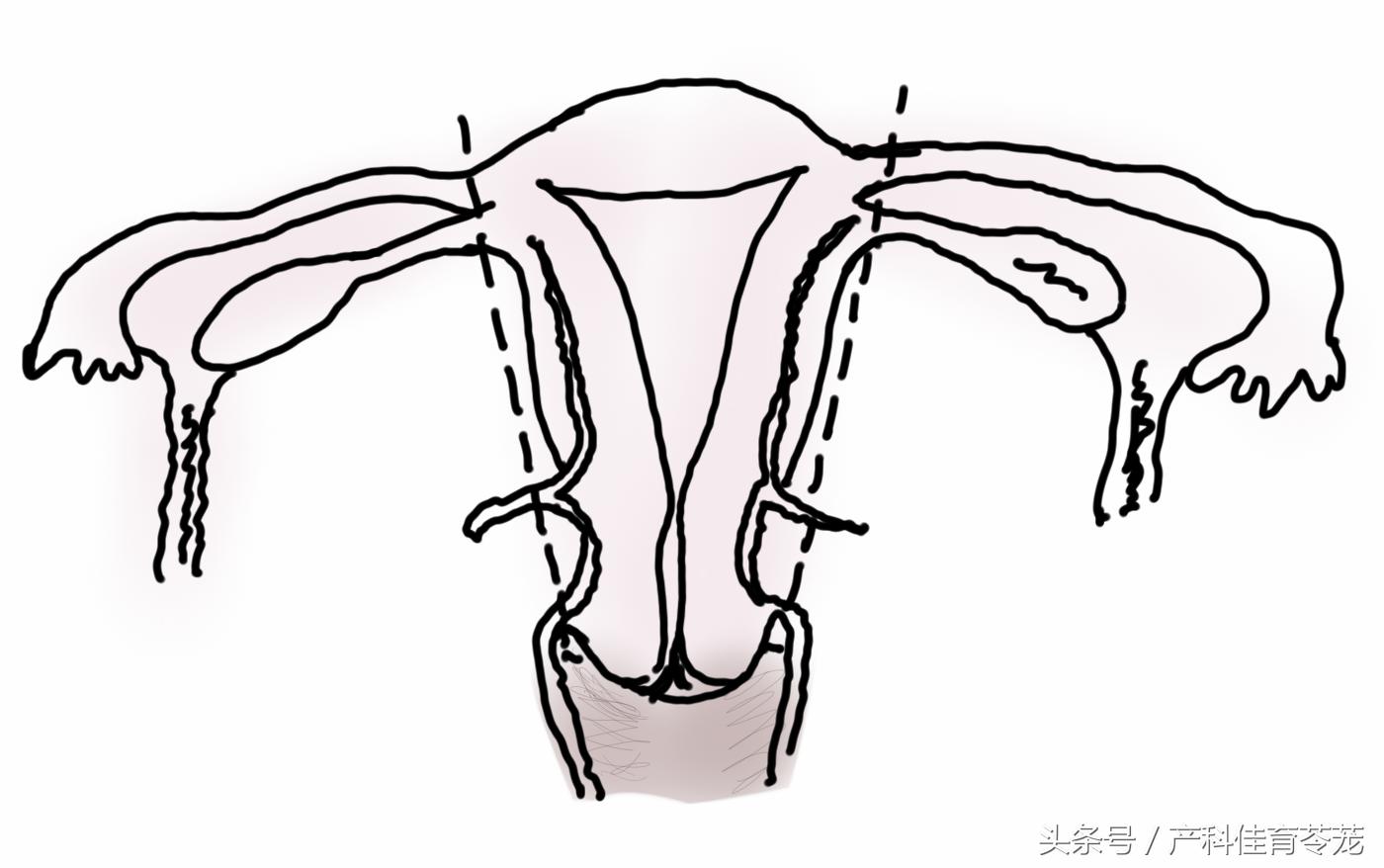 子宫切割还会分泌液体吗,子宫敢乱切吗