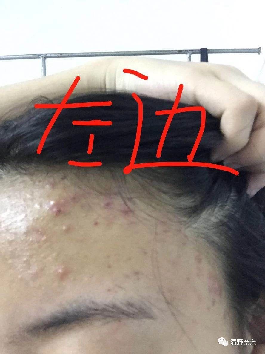 关了美颜也拒做海绵宝宝收毛孔大招vs针清后如何快速摆脱痘印？