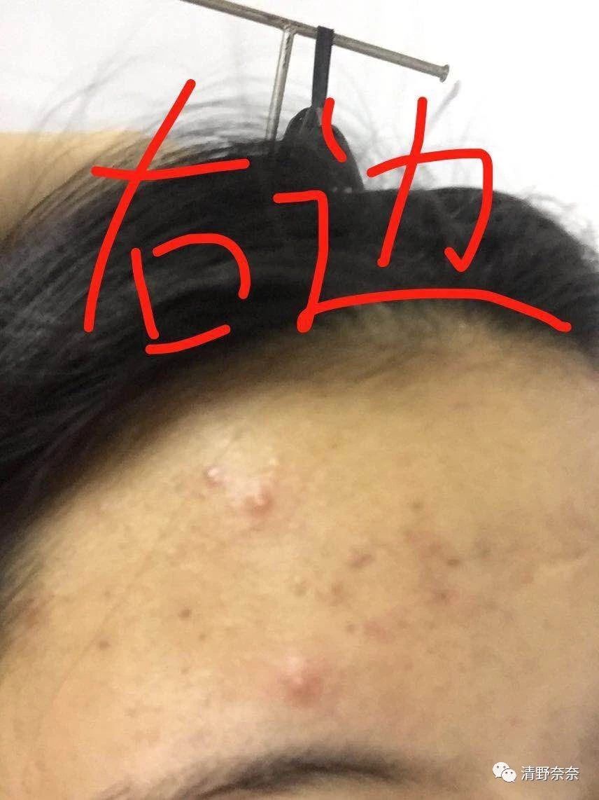 关了美颜也拒做海绵宝宝收毛孔大招vs针清后如何快速摆脱痘印？