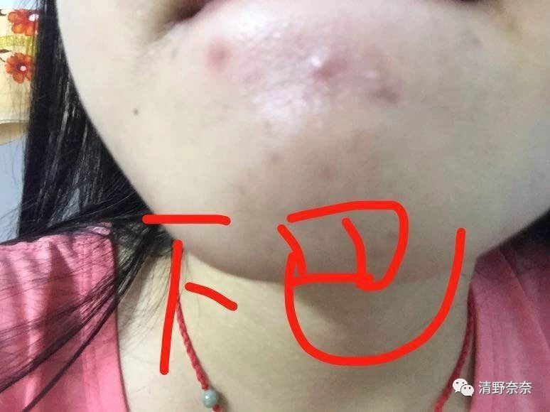 关了美颜也拒做海绵宝宝收毛孔大招vs针清后如何快速摆脱痘印？