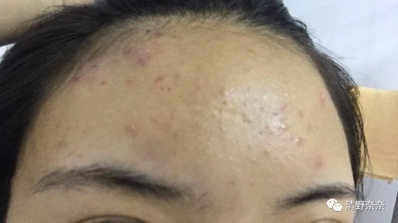 关了美颜也拒做海绵宝宝收毛孔大招vs针清后如何快速摆脱痘印？