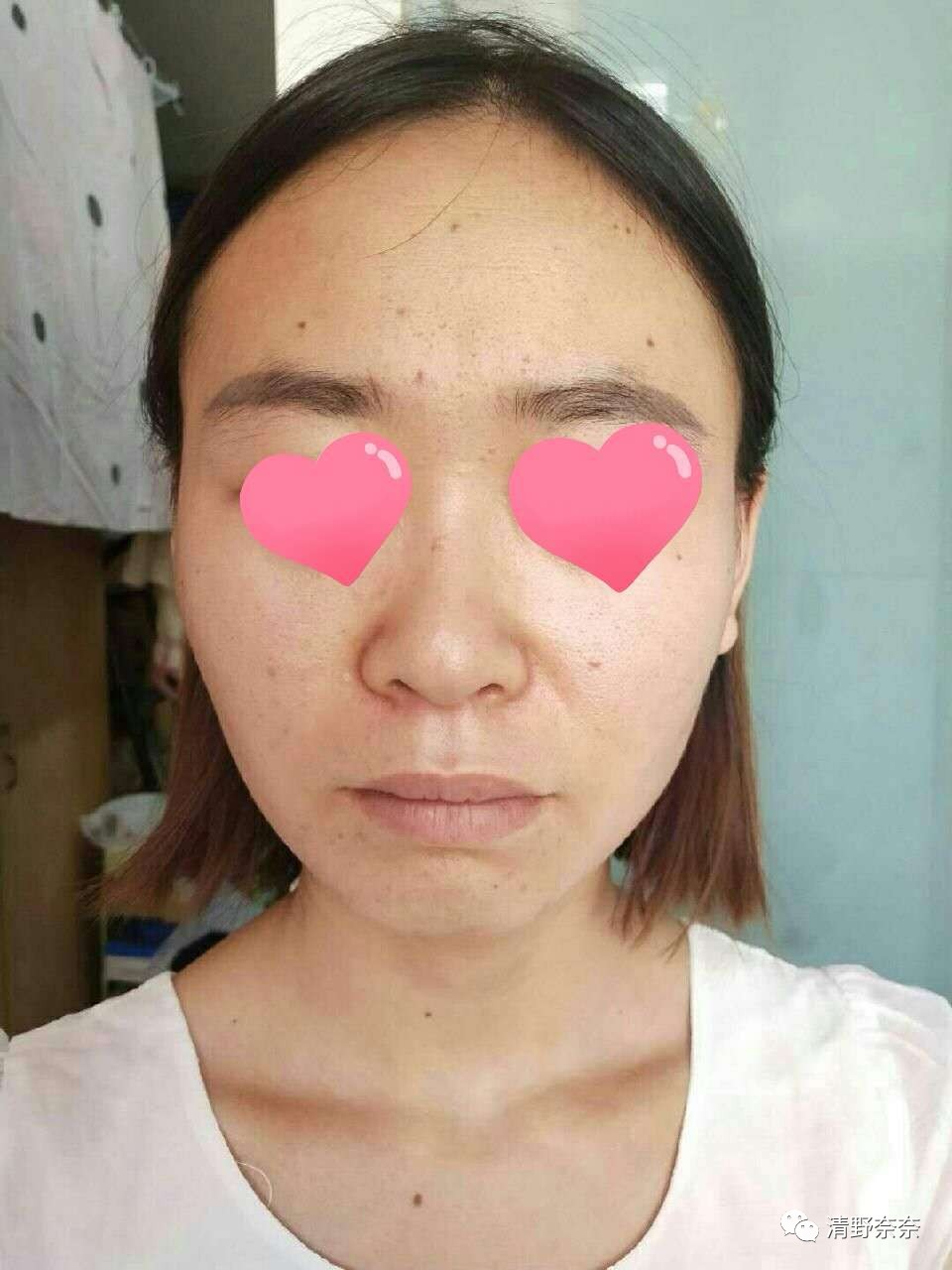 关了美颜也拒做海绵宝宝收毛孔大招vs针清后如何快速摆脱痘印？