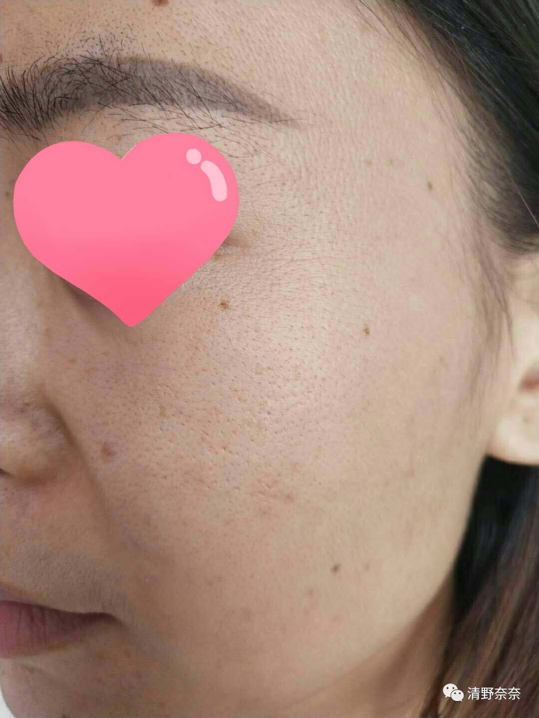 关了美颜也拒做海绵宝宝收毛孔大招vs针清后如何快速摆脱痘印？