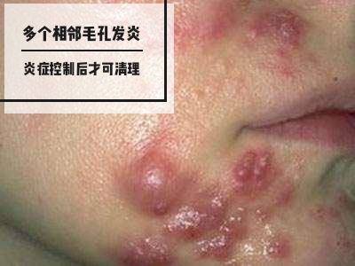 最可怕的痘痘,痘痘不可怕泛红才可怕