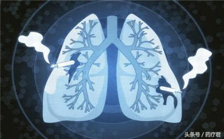 什么样的肺结节要警惕,什么是肺结节与肺癌的区别