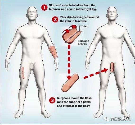 一出生就没了12个器官,一出生就没有肚脐