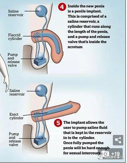一出生就没了12个器官,一出生就没有肚脐