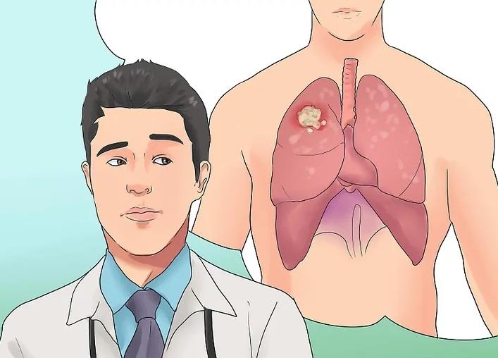 抽烟30年得肺癌的几率,二十年烟龄得肺癌几率