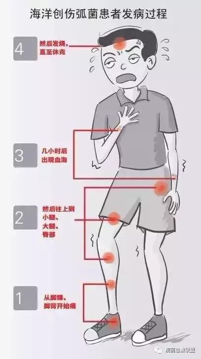 被鲈鱼背鳍扎了一下手指发肿,被鲈鱼扎了手指没流血能感染吗
