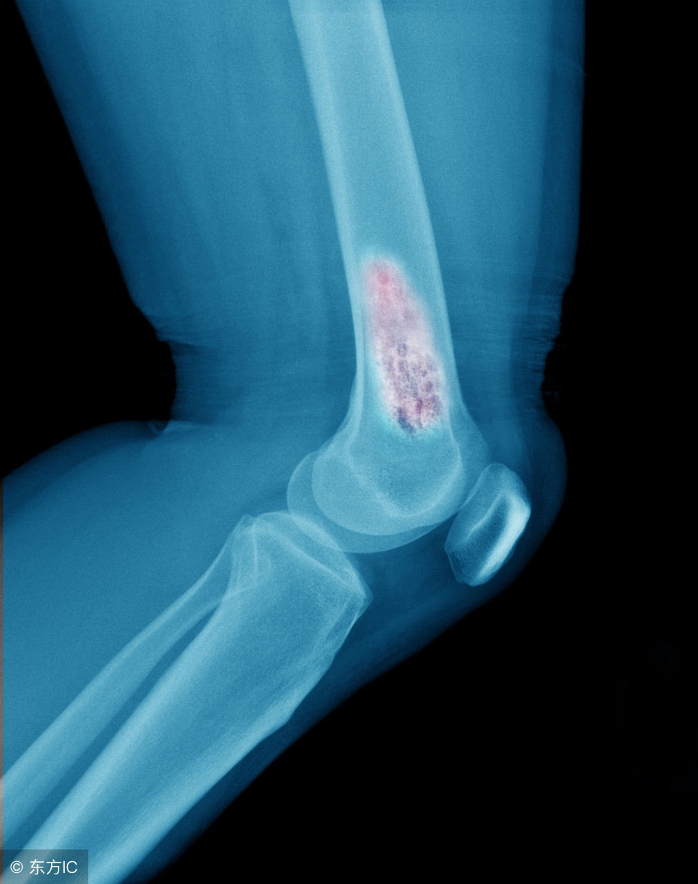 症状很像骨巨细胞瘤的肿瘤有哪些,转移的肿瘤一定是恶性的吗