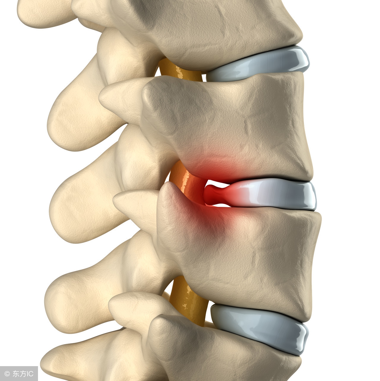 椎动脉型颈椎病怎么形成的,颈椎病会造成颈动脉斑块形成吗