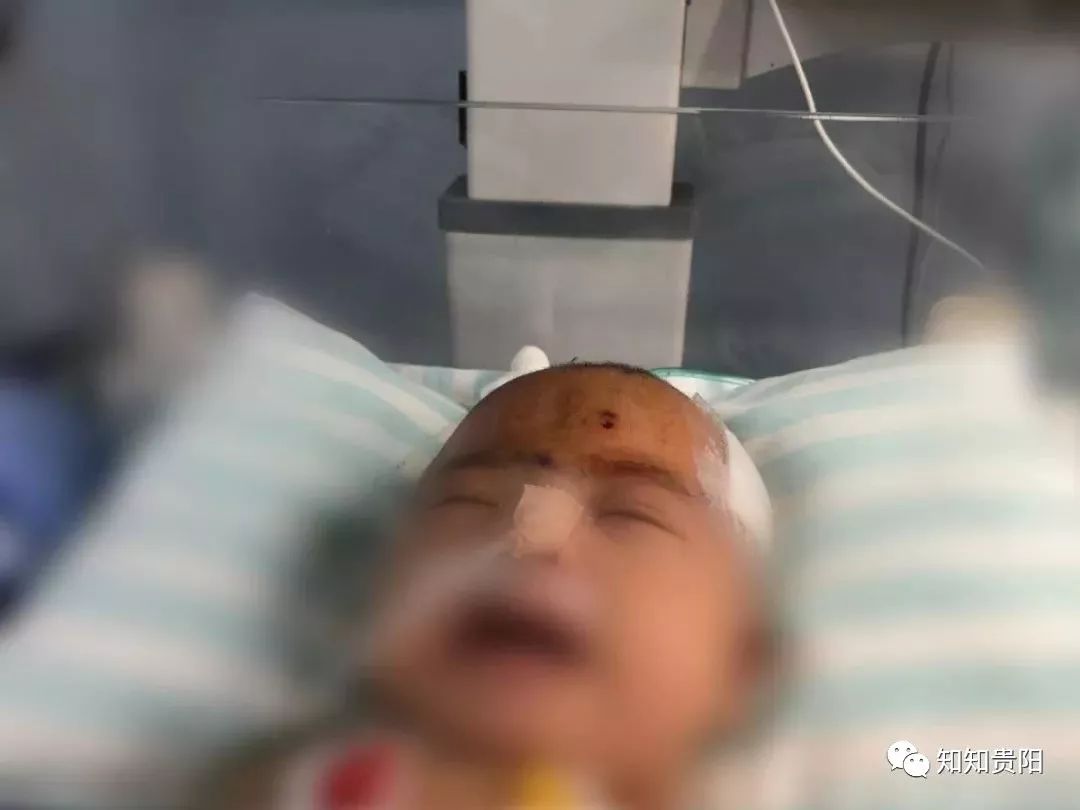 一岁宝宝脑出血手术成功率大吗,婴儿脑血管畸形脑出血后手术