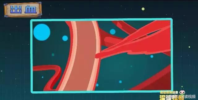 紧急救援脑梗,脑梗溶栓护理科普动画通俗易懂