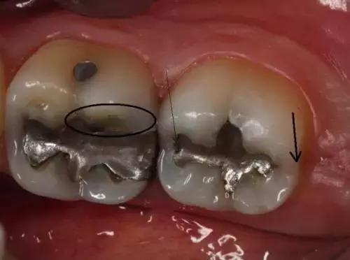 这一口烂牙，就能让你意识到*品毒**的破坏力有多恐怖