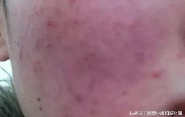 用了就烂脸的面膜,让人用了会烂脸的面膜