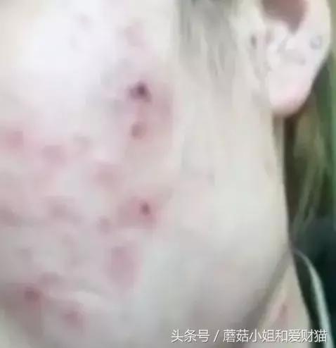 用了就烂脸的面膜,让人用了会烂脸的面膜