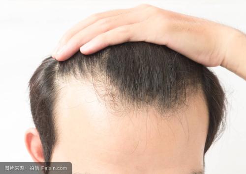 防脱发小妙招，解决你的燃眉之急