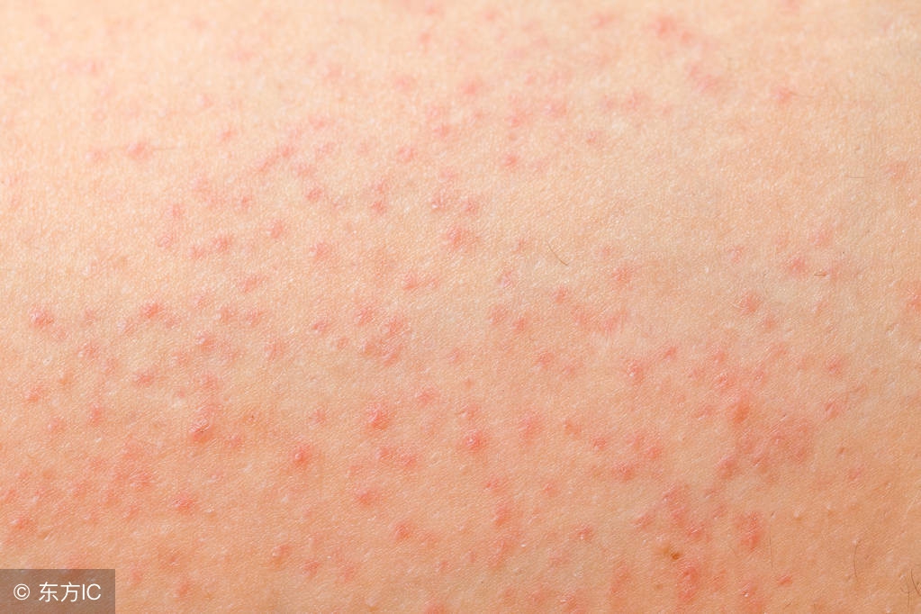 急性毛囊炎怎么引起的,一般毛囊炎是什么原因引起的