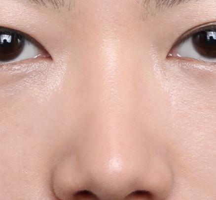 为什么有人的鼻子那么小,鼻子不够挺是什么原因