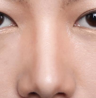 为什么有人的鼻子那么小,鼻子不够挺是什么原因