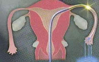 妇科通水是什么时间去最好,妇科通水建议女性做吗