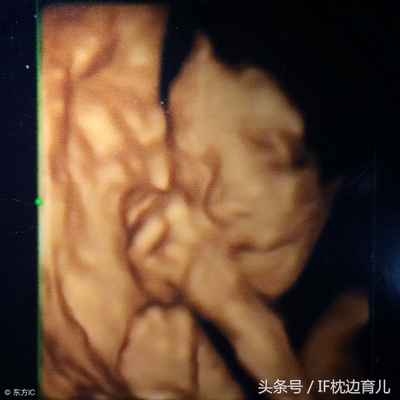 怀孕25周做四维说胎儿太大正常吗,四维医生说鼻子挺是什么意思